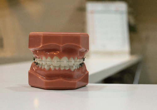 Regular braces on false teeth