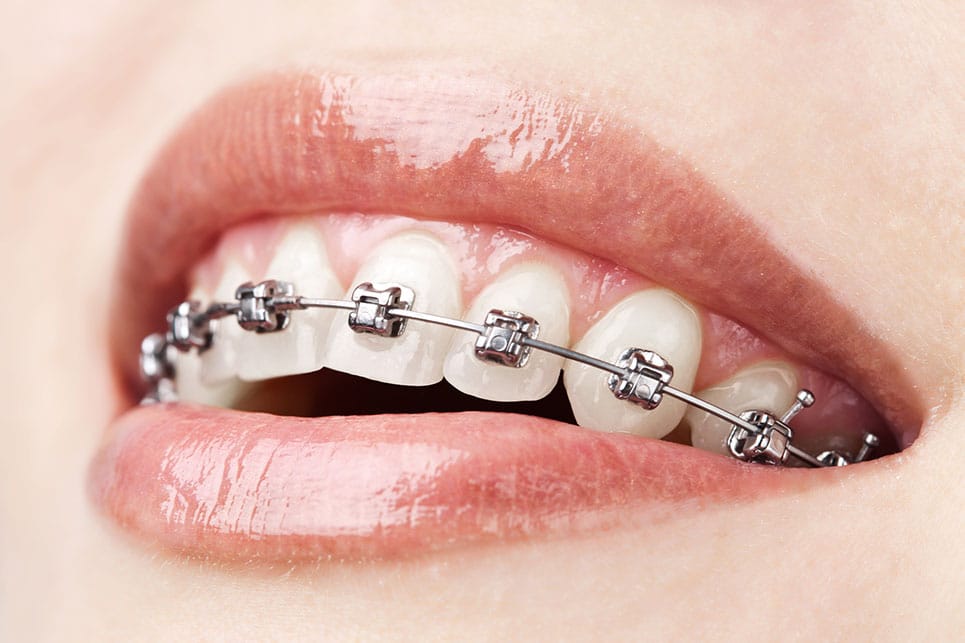 close up teeth with braces