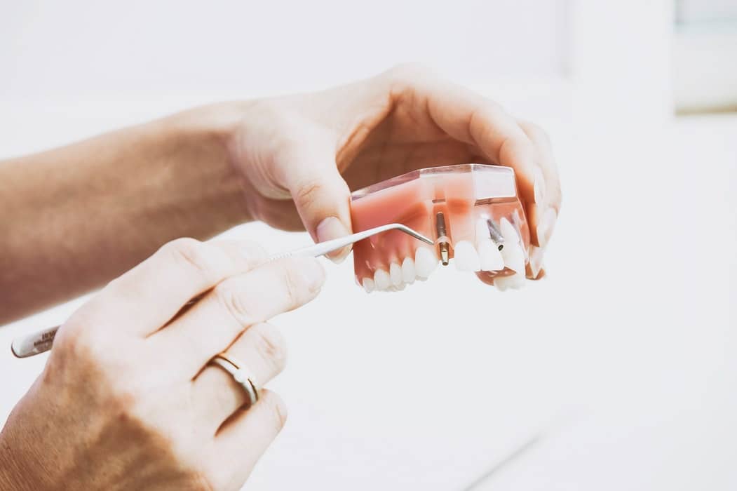 Dentist holding fake teeth to explain dental implants