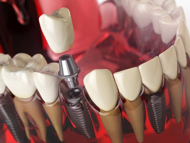 model of a tooth implant