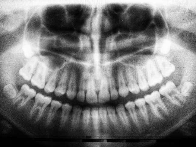 a dental xray with frontal view of the teeth